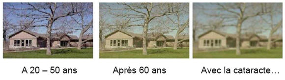 Comment la vue s'altère, par SeniorSphère seniorspherevieillissementdelavue.jpg