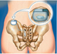 Incontinence - Medtronic